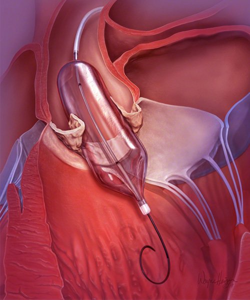 balloon-valvuloplasty
