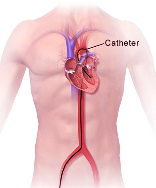 cardiac-catheterization