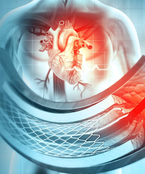 coronary-angiography
