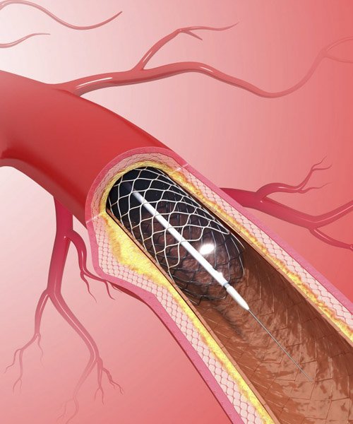 coronary-angioplasty