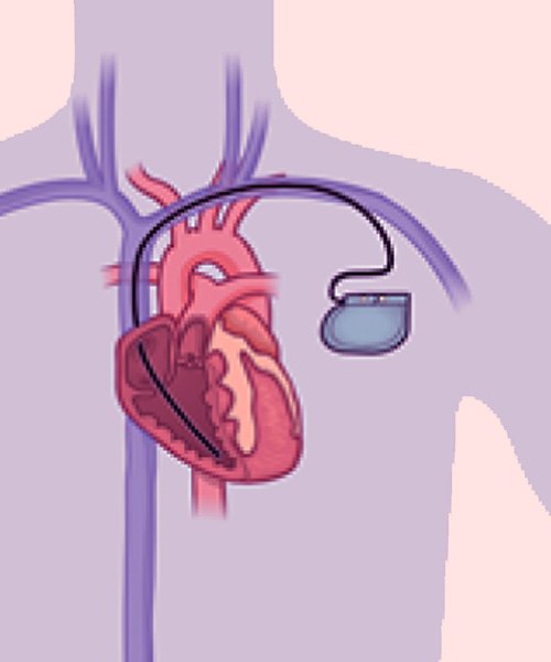 pacemaker-implantation
